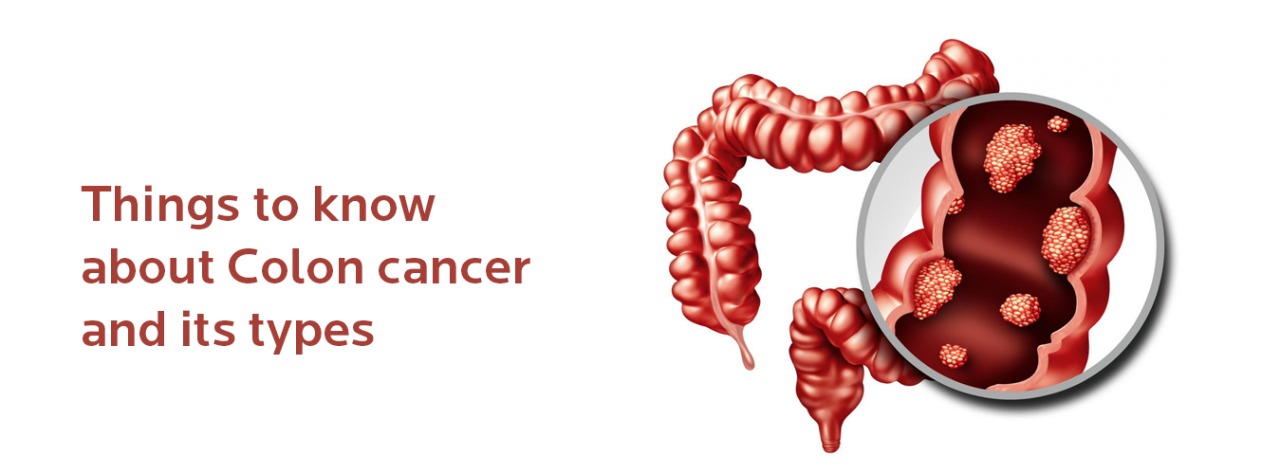 Things to know about Colon cancer and its types