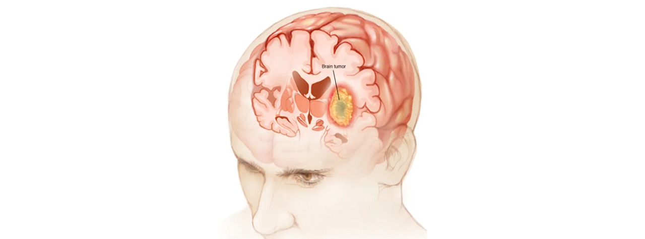 Brain Cancer: Its Causes, Symptoms, and Treatment