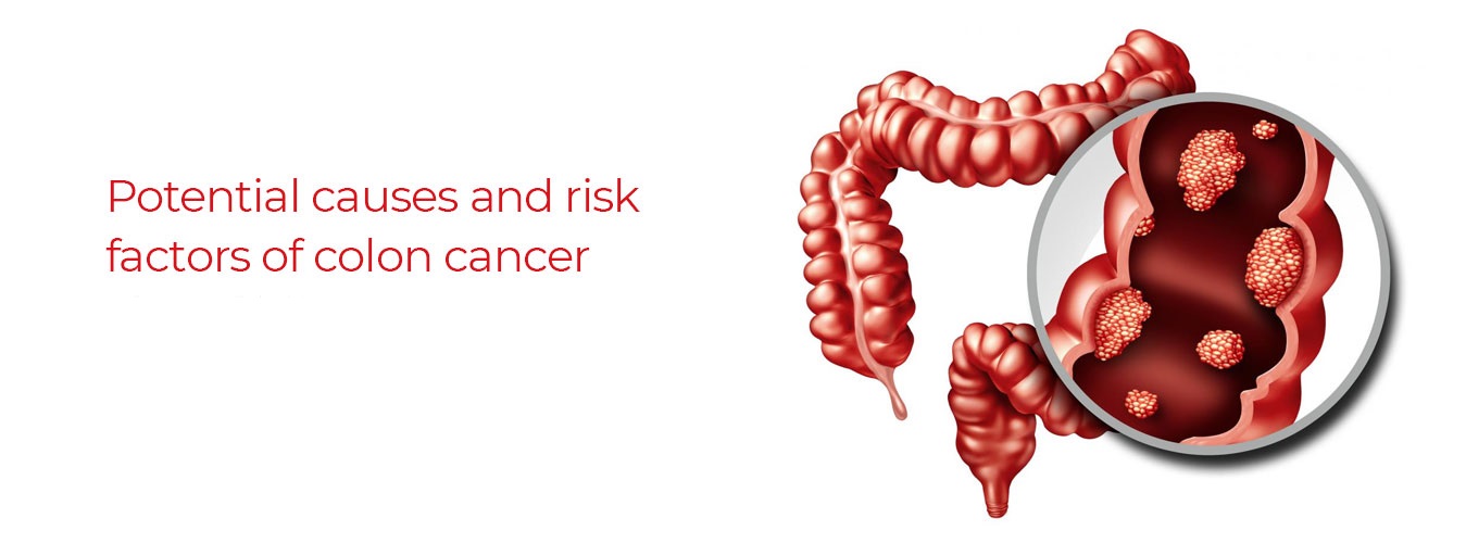 Potential causes and risk factors of colon cancer
